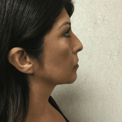 Liposuction-08 | After Liposuction 3