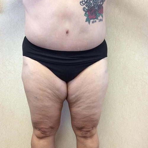 Liposuction-09 | After Liposuction 2