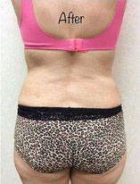 Liposuction-10 | After Liposuction