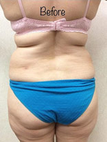 Liposuction-10 | Before Liposuction