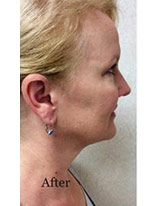 Liposuction-11 | After Liposuction 1