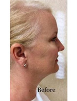 Liposuction-11 | Before Liposuction 1