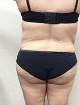 Liposuction-14 | After Liposuction