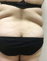 Liposuction-14 | Before Liposuction