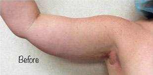 Liposuction-15 | After Liposuction