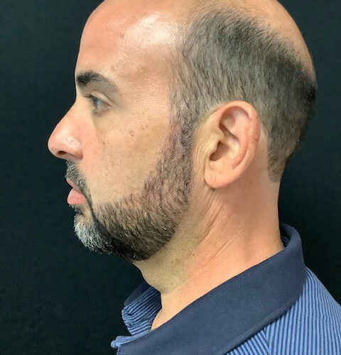 Liposuction-16 | After Liposuction