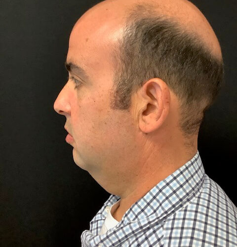 Liposuction-16 | Before Liposuction