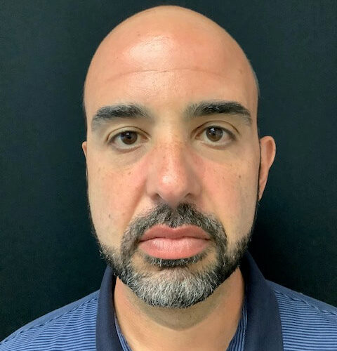 Liposuction-16 | After Liposuction 2