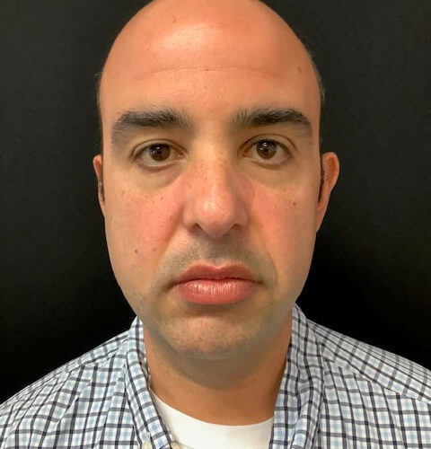 Liposuction-16 | Before Liposuction 2