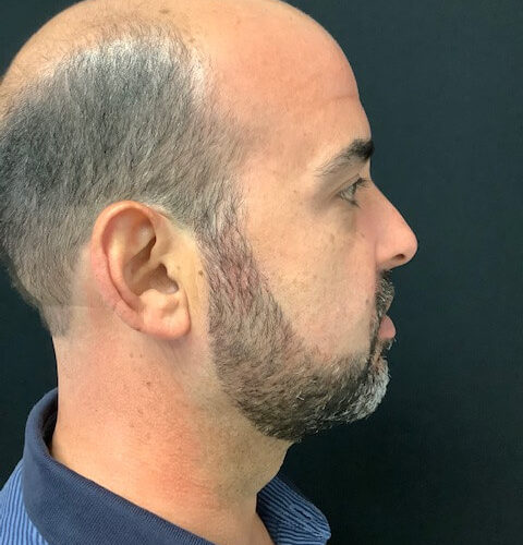 Liposuction-16 | After Liposuction 3