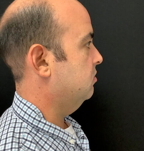 Liposuction-16 | Before Liposuction 3