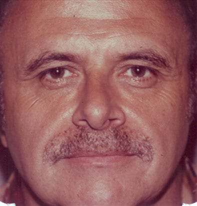 Male-Cosmetic-Surgery-01 | After Male Cosmetic Surgery 2