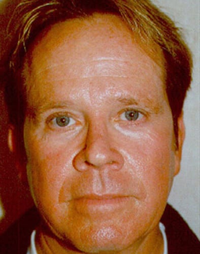 Male-Cosmetic-Surgery-04 | After Male Cosmetic Surgery