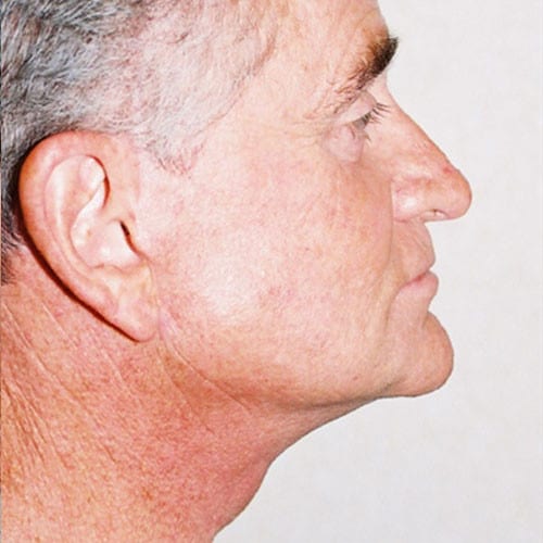 Male-Cosmetic-Surgery-06 | After Male Cosmetic Surgery