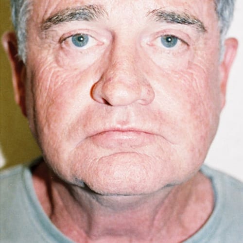 Male-Cosmetic-Surgery-06 | Before Male Cosmetic Surgery 2