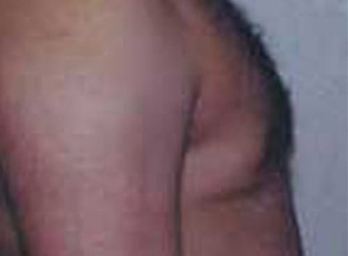 Male-Cosmetic-Surgery-08 | After Male Cosmetic Surgery