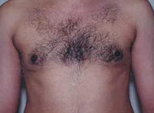 Male-Cosmetic-Surgery-08 | After Male Cosmetic Surgery 2