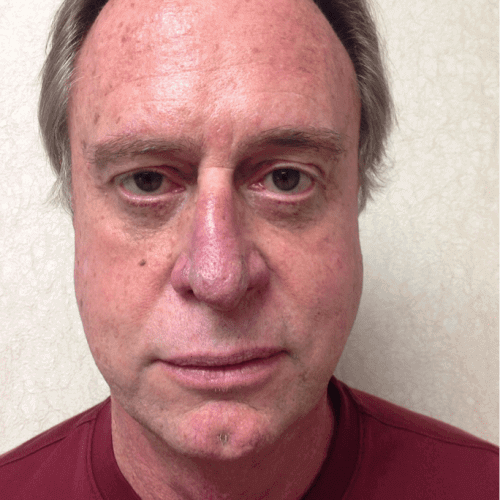 Male-Cosmetic-Surgery-09-2 | After Male Cosmetic Surgery