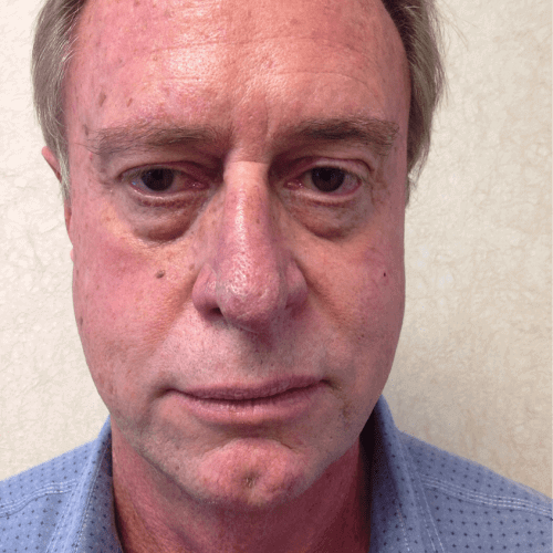 Male-Cosmetic-Surgery-09-2 | Before Male Cosmetic Surgery