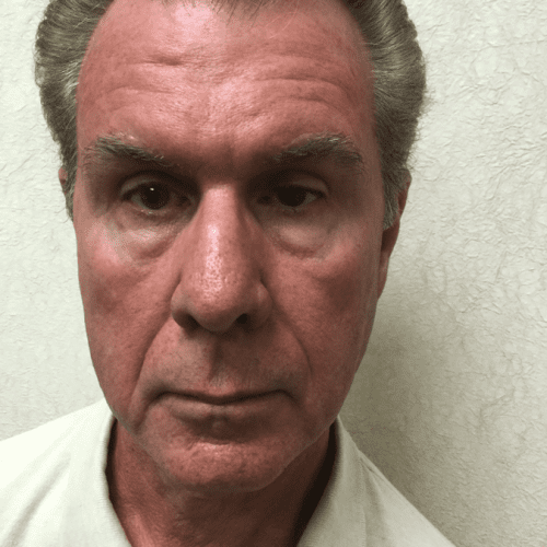 Male-Cosmetic-Surgery-10 | After Male Cosmetic Surgery