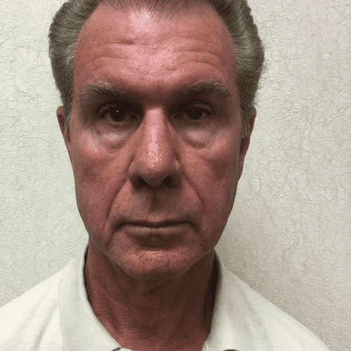 Male-Cosmetic-Surgery-10 | After Male Cosmetic Surgery 2