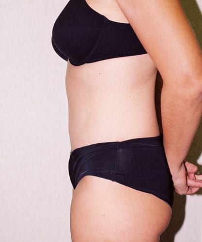 Mommy-Makeover-01 | After Mommy Makeover