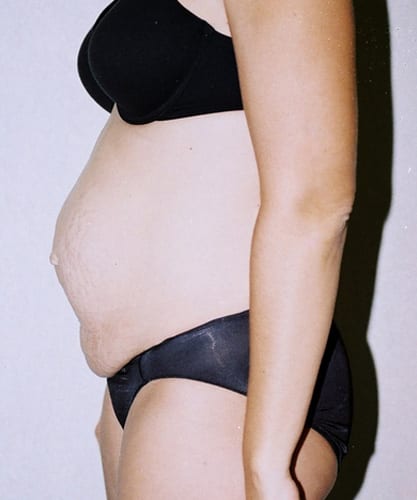 Mommy-Makeover-01 | Before Mommy Makeover