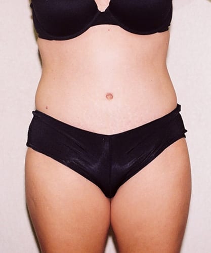 Mommy-Makeover-01 | After Mommy Makeover 2