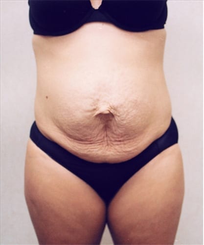 Mommy-Makeover-01 | Before Mommy Makeover 2