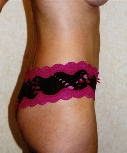 Mommy-Makeover-02 | After Mommy Makeover