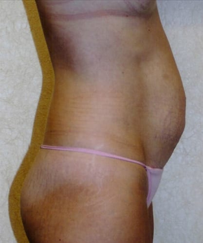 Mommy-Makeover-02 | Before Mommy Makeover