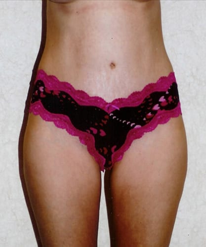 Mommy-Makeover-02 | After Mommy Makeover 2