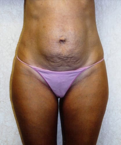 Mommy-Makeover-02 | Before Mommy Makeover 2