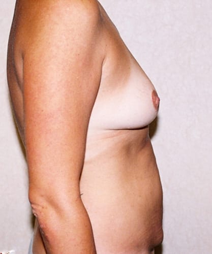 Mommy-Makeover-03 | Before Mommy Makeover