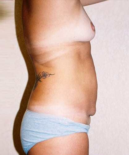 Mommy-Makeover-03 | Before Mommy Makeover 3