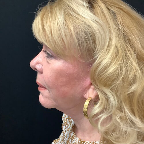 Neck-Lift-01 | After Neck Lift