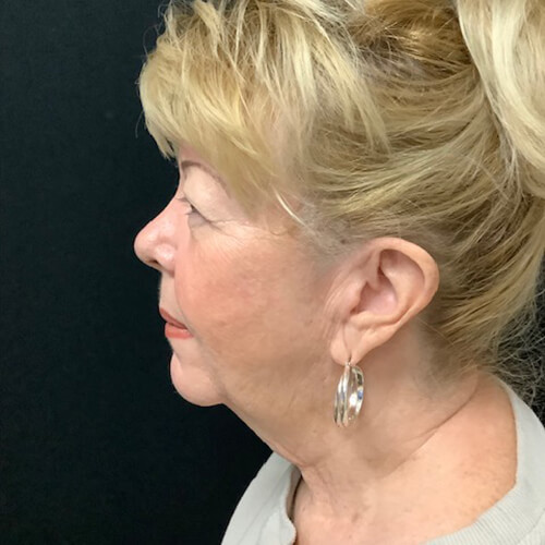 Neck-Lift-01 | Before Neck Lift