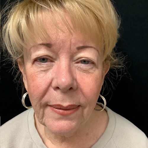 Neck-Lift-01 | Before Neck Lift 2