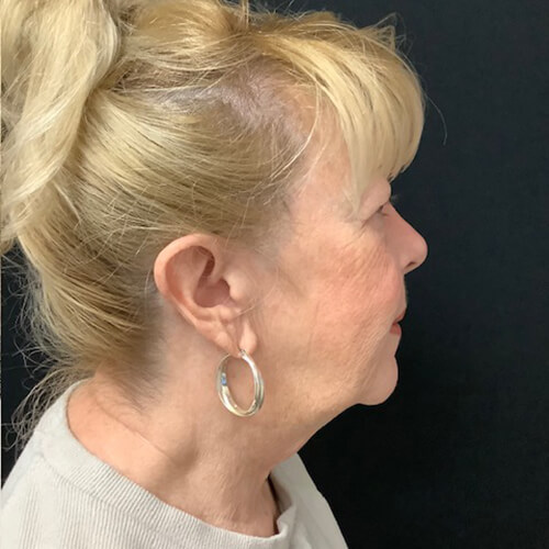 Neck-Lift-01 | Before Neck Lift 3