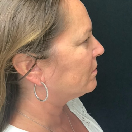 Neck-Lift-02 | Before Neck Lift