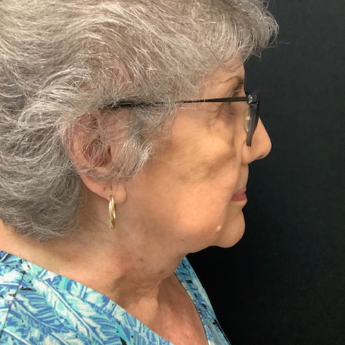 Neck-Liposuction-Patient-02 | After Neck Liposuction