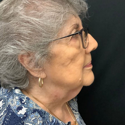 Neck-Liposuction-Patient-02 | Before Neck Liposuction