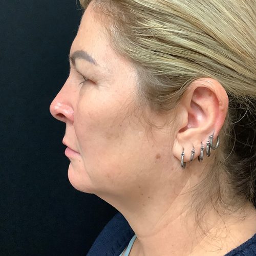 Neck-Liposuction | Before Neck Liposuction