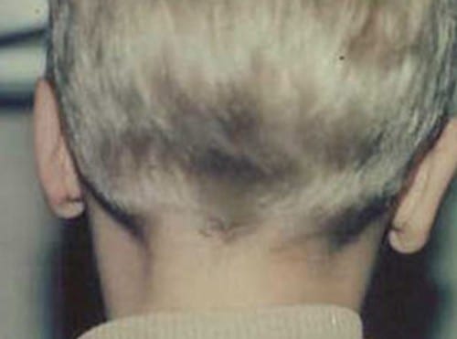 Otoplasty-01 | After Otoplasty