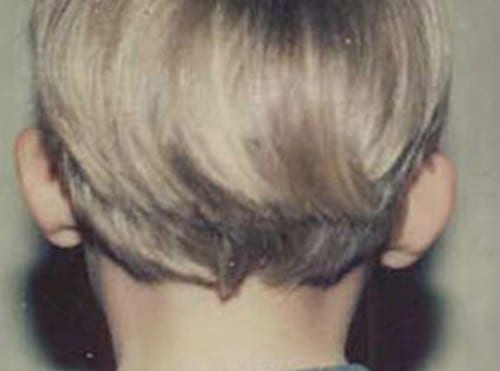 Otoplasty-01 | Before Otoplasty