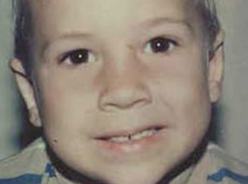 Otoplasty-01 | After Otoplasty 2