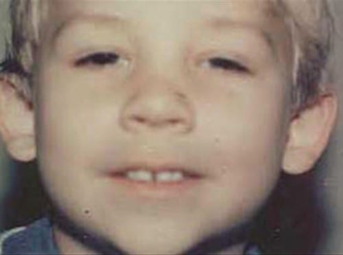 Otoplasty-01 | Before Otoplasty 2