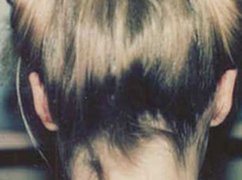 Otoplasty-02 | After Otoplasty