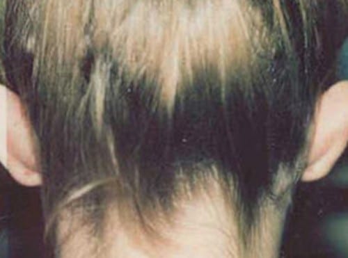 Otoplasty-02 | Before Otoplasty