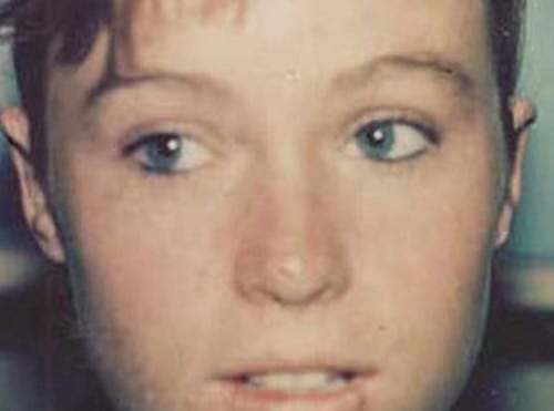 Otoplasty-02 | After Otoplasty 2